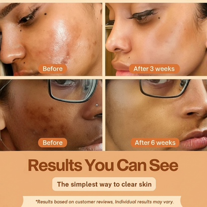 Nurea™ Kojic + Turmeric Peel Spray